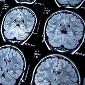 Image of magnetic resonance imaging. MRI Photosensitive Epilepsy/Seizures Neurological Diseases. A.R.M. Action Resource Management.